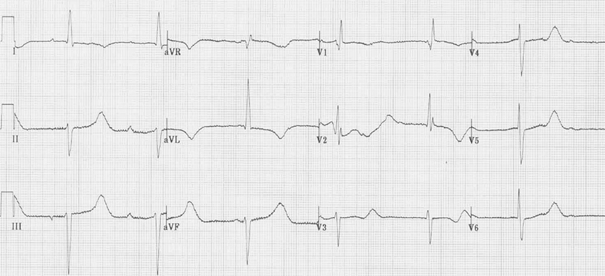 ECG acquired long QT syndrome, hypothermia