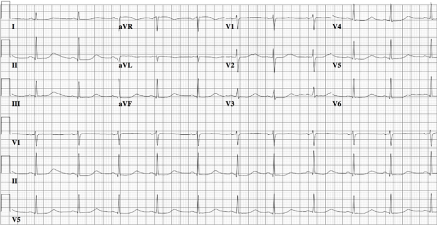 ECG congenital long QT syndrome, LQTS type 1