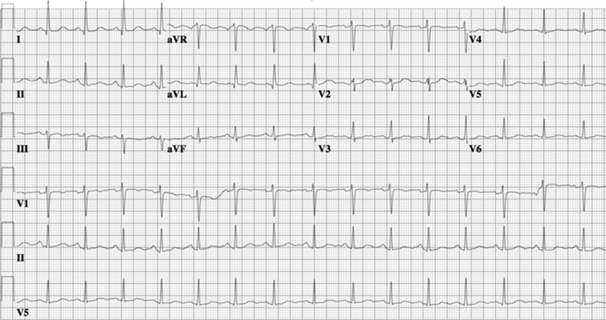 ECG congenital long QT syndrome, LQTS type 2