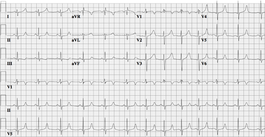 ECG congenital long QT syndrome, LQTS type 3