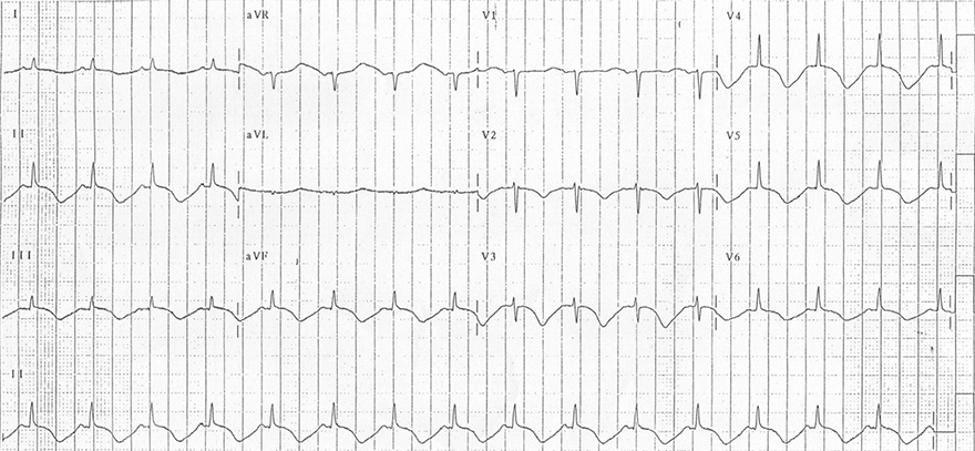 ECG acquired long QT syndrome, cerebral T waves, intracranial pressure, subarachnoid haemorrhage