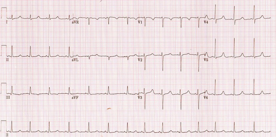 ECG acquired long QT syndrome, hypocalcaemia