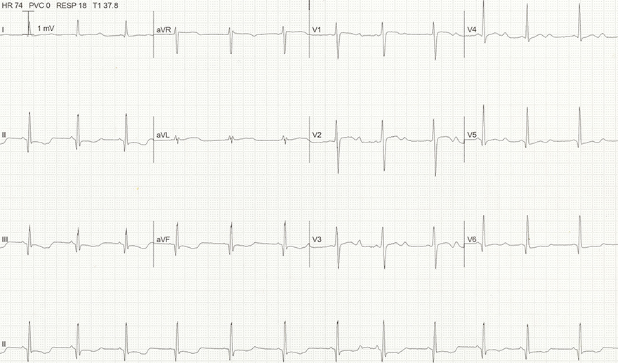 ECG acquired long QT syndrome, hypokalemia