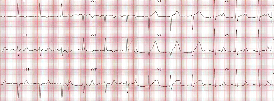 ECG antero-septal STEMI, acquired long QT syndrome