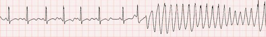 ECG long QT syndrome, venricular arrhythmia Torsades de Pointes