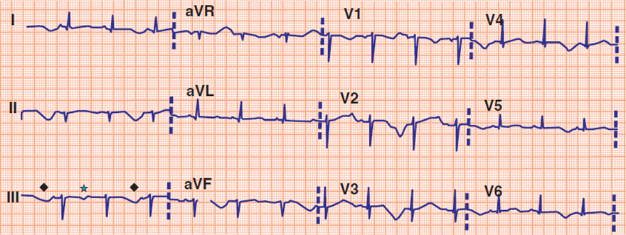 ECG acquired long QT syndrome, T wave alternans