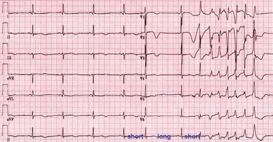 ECG long QT syndrome, Torsades de Pointes, short-long-short RR interval