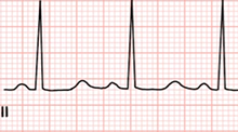 ECG Congenital (acquired) long QT syndrome (LQTS)