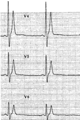 ECG short QT syndrome (short QT interval 340ms)