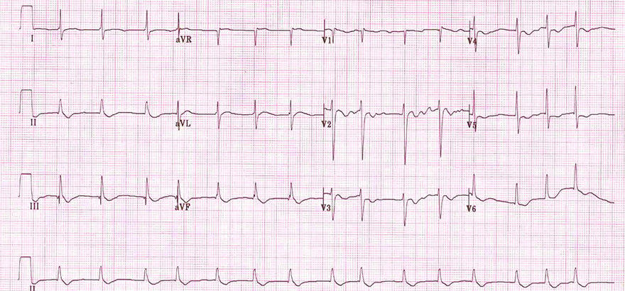 ECG digoxin effect, atrial fibrillation, downsloping ST depression