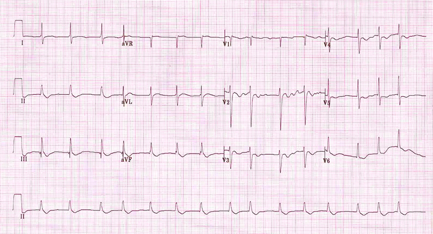 ECG atrial tachy-fibrillation and digoxin effect