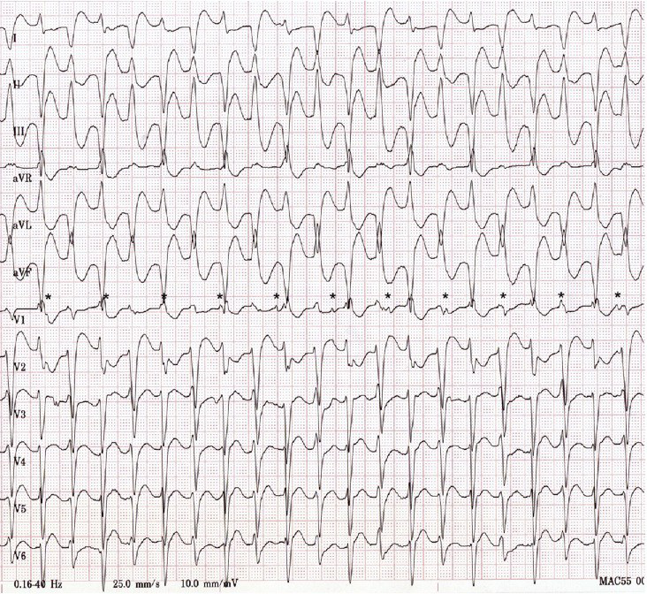 ECG digoxin toxicity, bidirectional ventricular tachycardia, AV dissociation, broad complex tachycardia