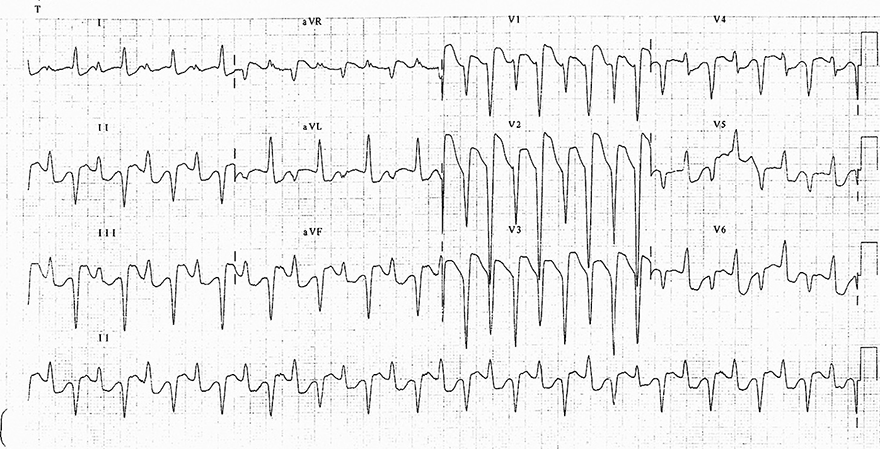 ECG digoxin toxicity, bidirectional ventricula tachycardia, broad QRS complexes