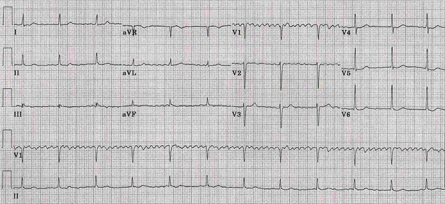 ECG digoxin toxicity, coarse regularised atrial fibrillation, Complete (3rd degree) heart block