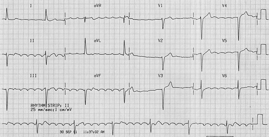 ECG digoxin toxicity atrial flutter, slow ventricular response, rate