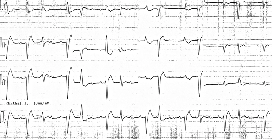 ECG digoxin toxicity, focal atrial tachycardia, high grade AV block, premature ventricular complexes