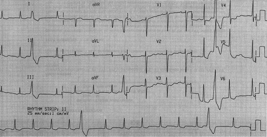 ECG digoxin, sinus rhythm, sagging, downsloping ST depression, premature ventricular complex