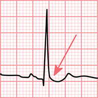 ECG Digoxin downsloping, sagging ST depression