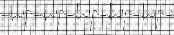 ECG digoxin toxicity, sinus rhythm, ventricular bigeminy