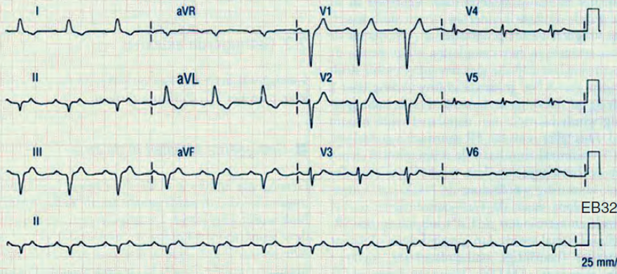 ECG digitalis toxicity, poisoning, focal atrial tachycardia, second AV block, slow ventricular response