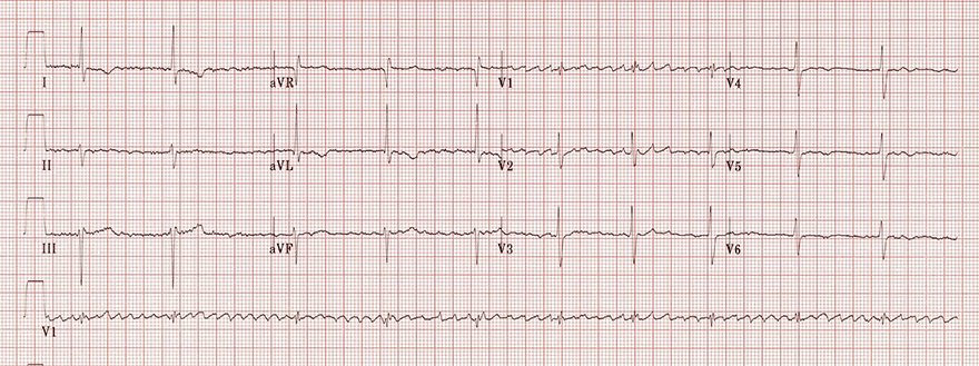 ECG Regularised atrial fibrillation, coarse atrial fibrillation, 3rd degree AV block, junctional escape rhythm