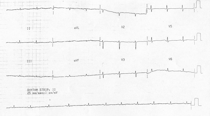 ECG severe hypothyroidism, myxoedema triad: sinus bradycardia, low qrs voltage, flattened T waves