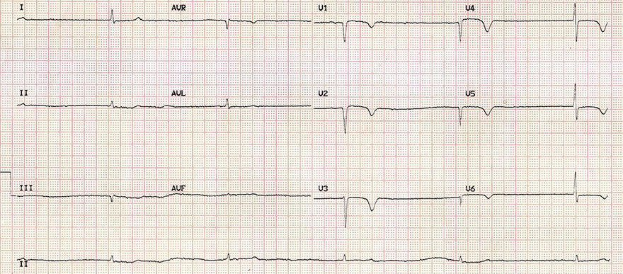 ECG myxoedema coma triad, sinus bradycardia, low QRS voltage, T wave inversion, elevated TSH, low T4