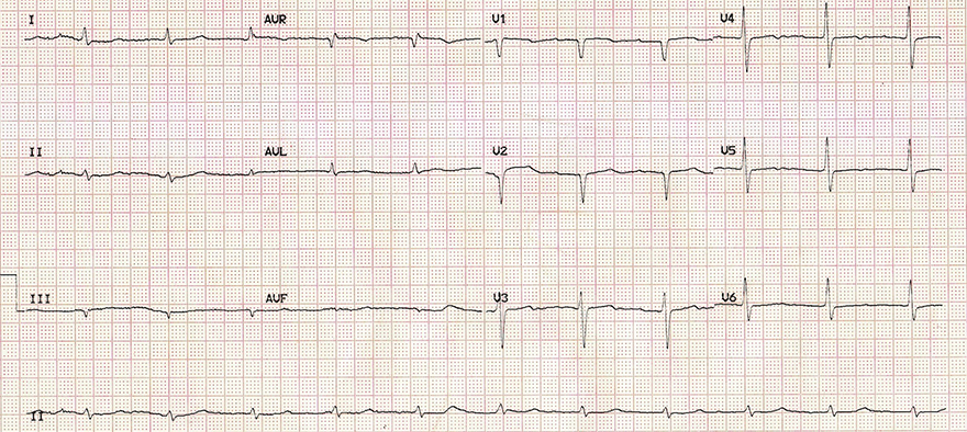 ECG myxoedema coma after treatment, sinus rhythm, normal T waves