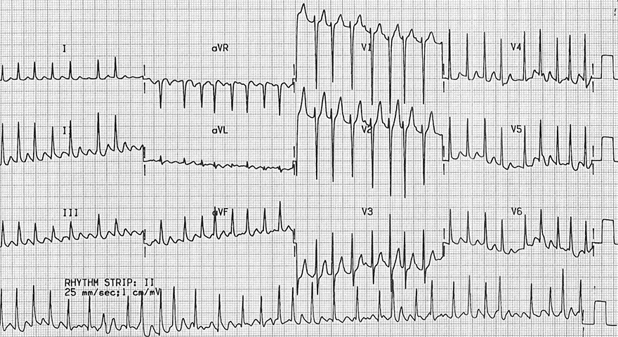 ECG atrial tachy-fibrillation, hyperthyroidism, thyrotoxicosis, high T4 thyroxine, low serum TSH