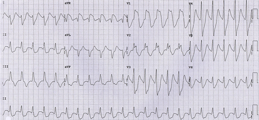 ECG tricyclic antidepressant (TCA) overdose, toxicity, sinus bradycardia, broad qrs complexes