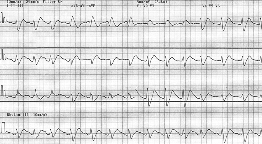 ECG flecainid poisoning, toxicity, overdose, sinus rhytm, broad qrs, giant r aVR