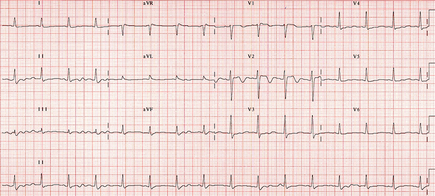 ECG tricyclic antidepressant (TCA) overdose, sodium channel blocker toxicity, resolution TCA toxicity with treatment (bicarbonate and hyperventilation)