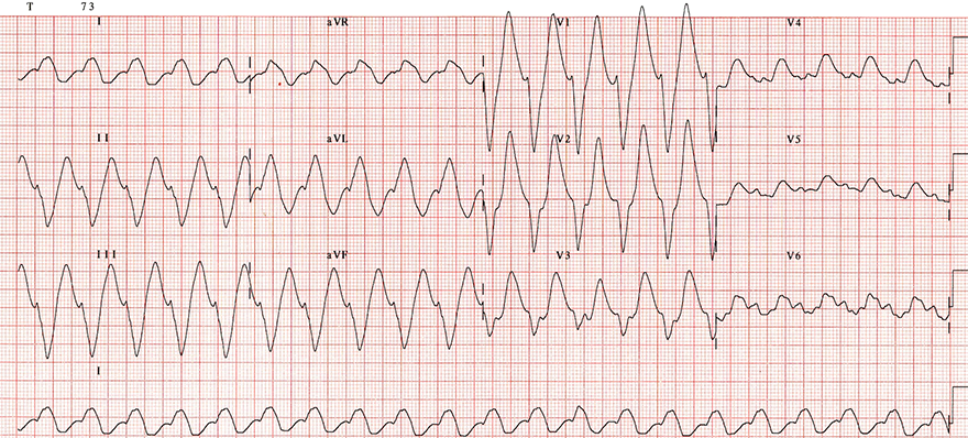 ECG sine wave (hyperkalaemia),  tricyclic antidepressant (TCA) overdose, sodium channel blocker worsening toxicity 