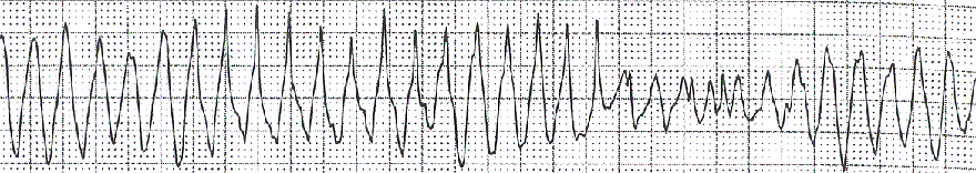 ECG beta blockers overdose sotalol, torsades de pointes