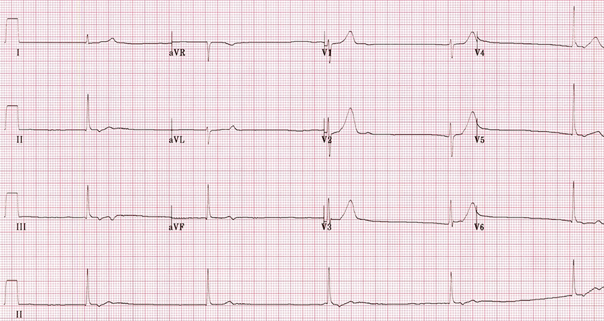 ECG verapamil calcium channel blocker toxicity, non-dihydropyridine, junctional rhythm