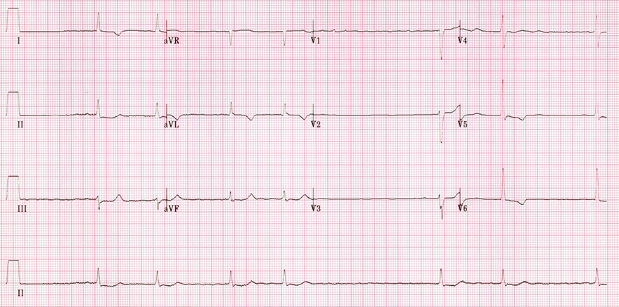 ECG atrial brady fibrillation