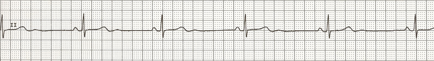 ECG criteria sinus bradycardia, heart rate 35bpm, normal P waves, narrow QRS complexes, normal PR interval