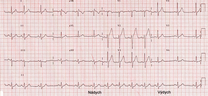 ECG respiratory sinus arrhytmia