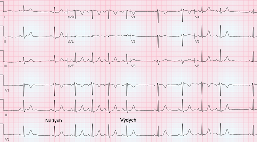 ECG respiratory sinus arrhytmia