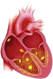 ventricular fibrillation mechanism, micro reentry