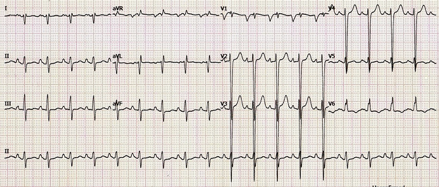 ECG Ischaemic dilated cardiomyopathy, left ventricular hypertrophy, left atril enlargement, P mitrale, right atrial enlargement, P pulmonale