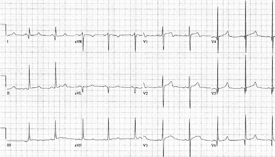 ECG asymmetrical septal hypertrophy cardiomyopathy, left ventricular hypertrophy, deep narrow Q waves