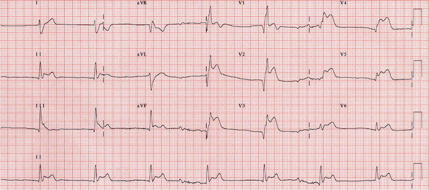 ECG takotsubo cardiomyopathy, Broken heart syndrome, Stress cardiomyopathy, Apical ballooning syndrome