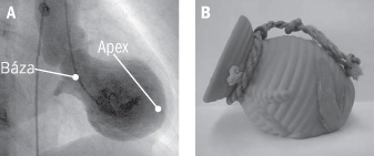 Takotsubo apex akinesis dyskinesis, base hyperkinesis