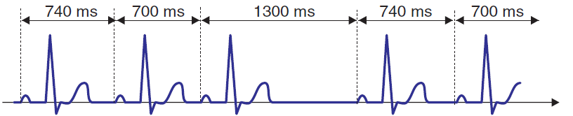 ECG 2nd degree SA block, exit block, Wenckebach