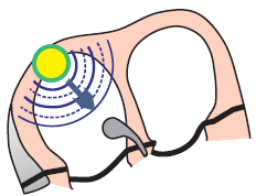 SA node and Sinoatrial first degree block