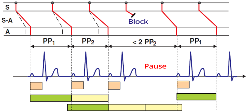 ECG and Laddergram 2nd degree sinoatrial (SA) block, Wenckebach