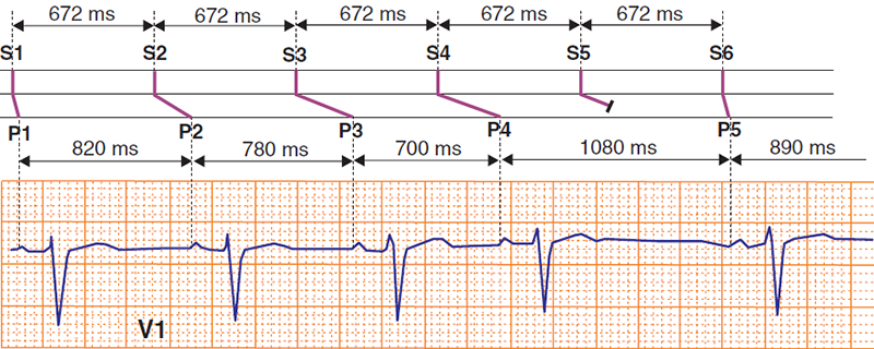 ECG and Laddergram, 2nd degree sinoatrial block, wenckebach 