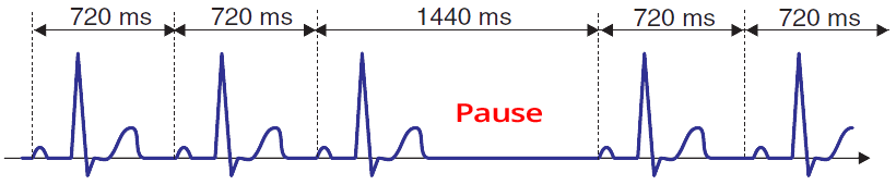 ECG second 2nd degree SA block, type 2, PP interval with pause