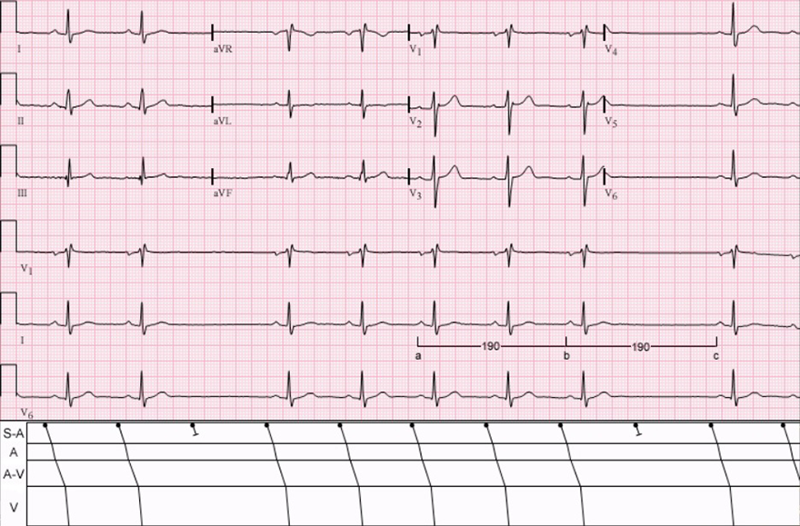 ECG and Laddergram, 2nd degree SA block, type 2, sa exit block